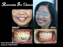 Prosthetic Dentistry in Angeles City