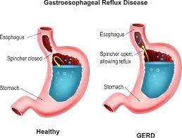 Diagram Of Gerd Pain Get Wiring Diagrams