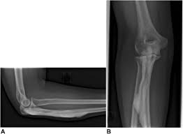 It forms the most pointed portion of the elbow and is opposite to the cubital fossa or elbow pit. Open Excision Of Olecranon Melorheostosis To Relieve Elbow Extension Block Journal Of Hand Surgery