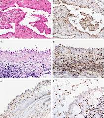 Mtap ihc discriminates sarcomatoid mesothelioma from . Bap1 Brca1 Associated Protein 1 Is A Highly Specific Marker For Differentiating Mesothelioma From Reactive Mesothelial Proliferations Modern Pathology