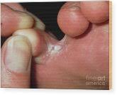 Image result for flegmona pedis)