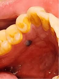 Image result for Gingiva