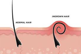 Ingrown hairs are an unfortunately common side effect of trying to remove hair. Is There Any Help For Treating Very Stubborn Chronic Ingrown Hairs The Dermatology Specialists