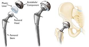 Titanium Cobalt On Polyethylene Hip Prosthetics Hip Replacement Total Hip Replacement Hip Replacement Surgery
