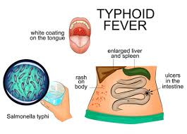 Typhi is in the same family of bacteria as the type spread by chicken and eggs, commonly known as salmonella poisoning. Typhoid