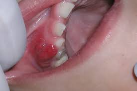 (alum) hydrated potassium aluminum sulphate is termed as alum. How Canker Sores And Mucocele Can Be Managed Naturally