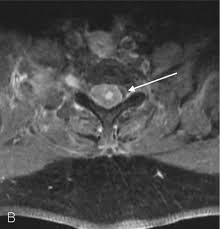 We did not find results for: Reversible Paraplegie Erfreulicher Ausgang Bei Verzogert Gestellter Diagnose Praxis