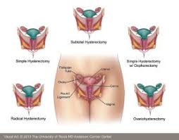 Symptoms of a tumor in the uterus usually affect both premenopausal and postmenopausal women. Uterine Cancer Diagnosis Md Anderson Cancer Center