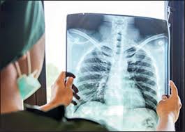 Lung cancer is cancer that forms in tissues of the lung, usually in the cells that line the air passages. Lung Cancer Control In The Uk Hit Badly By Covid 19 Pandemic The Lancet Oncology