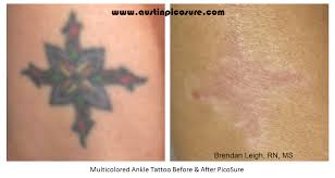 Here we are removing a medium black tattoo with an nd yag q switched laser, we are also using the zimmer cryo 6 machine which is a pain. Before After Photos Austinpicosure Com A Tattoo Removal Nurse S Notes