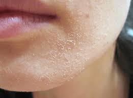 Jerawat pasir dan bekasnya bisa dihilangkan dengan baking soda. Ubat Hilangkan Jerawat Pasir Berubat 1