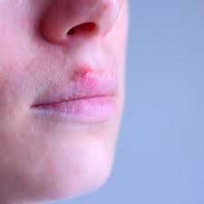 Yuck It S A Cold Sore Nima Skin Institute