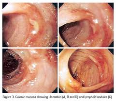 Image result for Allergic Colitis of Infancy