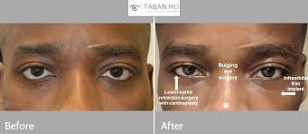 What do cats eyes mean? Before And After Canthoplasty Photos Mehryar Ray Taban Md