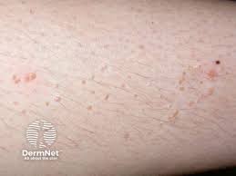 Image result for verrucae filiformes