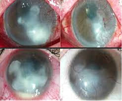 Herpes simplex disciform keratitis/herpes simplex dendritic keratitis; Treatments In Infectious And Allergic Conjunctivitis Is Immunomodulation The Future Intechopen