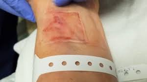 Image result for Skin Trauma
