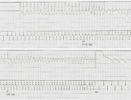 Vtach or vfib —— atrial: Cardioverter Defibrillators Icd Or Aicd Brandenburg Heart Center