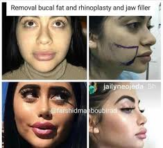 Pin By Ky 2 On The Plastics Perfect Nose Nose Job Rhinoplasty