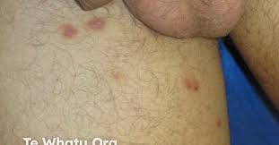 Image result for scabies on genitals