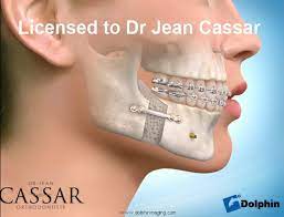 Adult Orthodontics Dr Jean Cassar Orthodontist