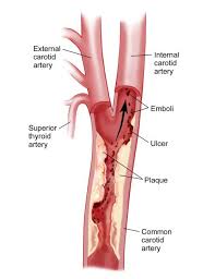 Image result for carotid artery