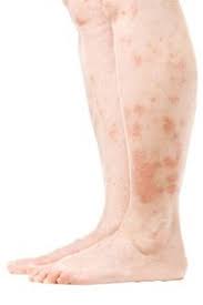 Image result for Stasis Dermatitis