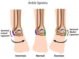 After two weeks of icing and immobilizing, and then 6 to 8 weeks of protecting the ankle. Sprained Ankle Symptoms Treatment Rehab