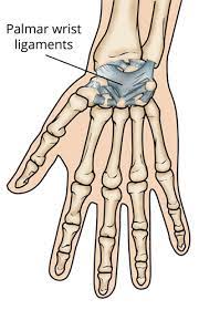 Wrist Sprains - Orthoinfo - Aaos