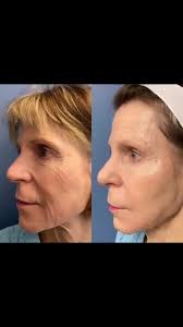 If you’ve experienced filler fatigue or are concerned about looking  overfilled and fake (although you know if you come to me you have nothing  to worry about), consider biostimulatory fillers instead. ...