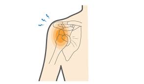 Image result for Shoulder Dislocation