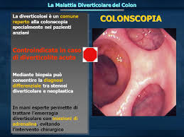 Stenosi diverticolare sintomatica del colon, di cosa si tratta. Malattia Diverticolare Ppt Video Online Scaricare