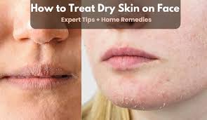Image result for Dry Skin