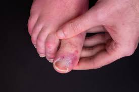 Image result for Chilblains