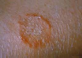 Ringworm on the scalp (tinea capitis) usually needs to be treated with prescription antifungal medication taken by mouth for 1 to 3 months. Ringworm Litchfield Veterinary Hospital Torrington Rd Litchfield