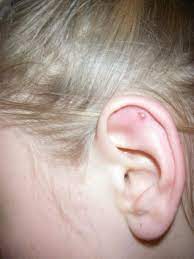 Cartilage Keloid Keloid Piercing Keloid Piercing