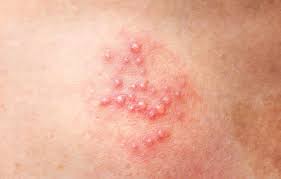 Image result for genital herpes