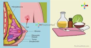 Is calcification in your breast always a sign of breast cancer? Pin On Health And Wellness