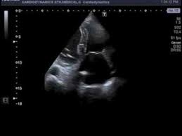 Acute myocarditis is one of the most challenging diagnosis in cardiology. Severe Myocarditis Following Pneumonia Youtube