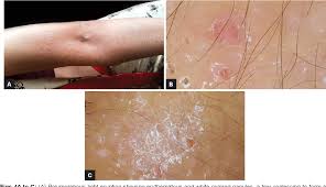 Image result for Polymorphous Light Eruption