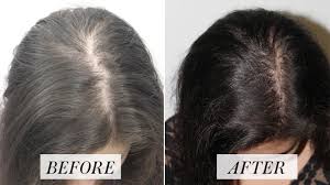 There Are A Number Of Reasons For Hair Loss And It S Not Exclusive To Men One Of Our Treatments Uses You Hair Loss Treatment Stop Hair Loss Natural Hair Loss