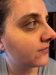 How to reduce dark circles under the eyes?