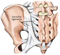 Image result for Sacroiliac Dysfunction
