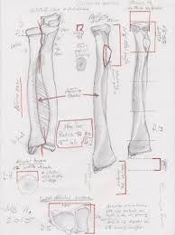 When a long bone breaks along its length similar to snapping a pencil in half. Tally