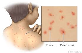 Image result for chickenpox