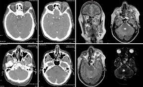 Los síntomas del enfisema pulmonar pueden parecerse a los de otras condiciones de los pulmones o problemas médicos. Manejo De La Mucormicosis Rino Orbito Cerebral Estrategias Para Evitar O Limitar Afeccion Intracraneal Y Mejorar La Supervivencia Sciencedirect