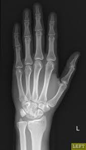 Image result for Lunate Dislocation