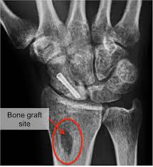 Image result for Scaphoid Bone