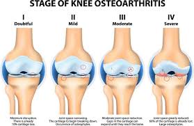 You should feel this exercise mostly in the front of your thigh. Knee Osteoarthritis Sun Orthopaedic