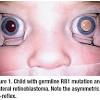 Childhood cancer can occur suddenly, without early symptoms, and have a high rate of cure. 1